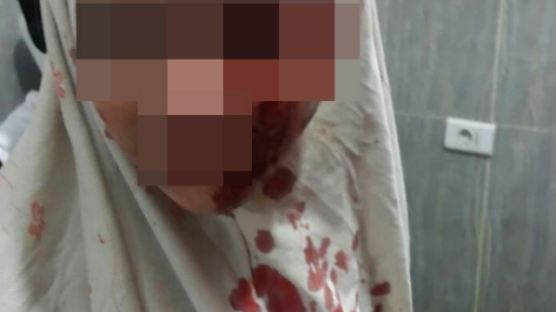 여학생 눈에 피, 5세 아기 척추에 폭탄…시리아는 지옥이었다