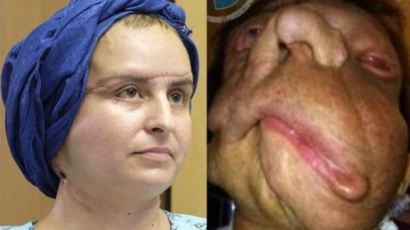 신경섬유종 수술 후 얼굴 되찾은 '폴란드의 심현희' 