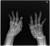 류마티스 관절염 환자의 손을 엑스레이 촬영한 사진 [사진 김완욱 가톨릭대 교수]