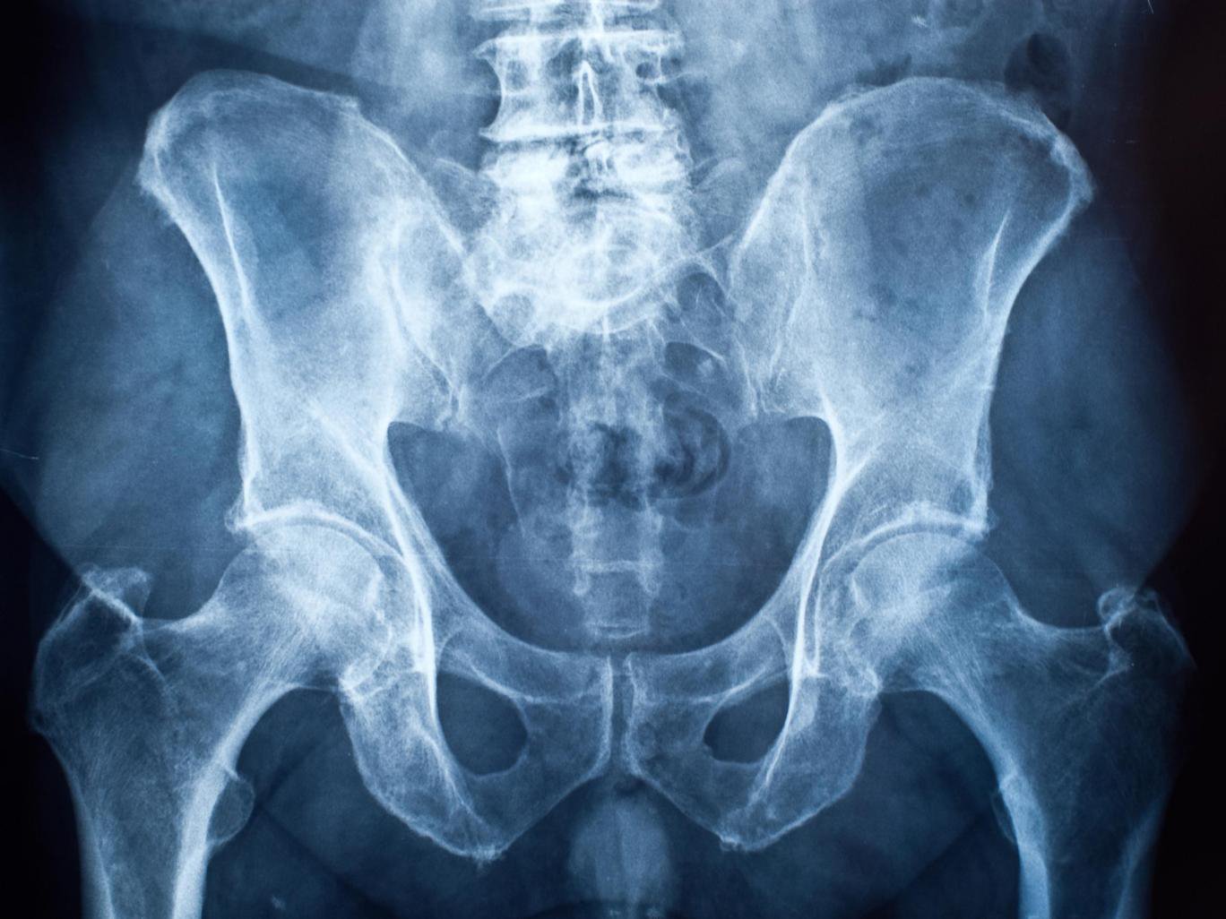 骨盆的X-射线 库存图片. 图片 包括有 女主持人, 诊断, 女性, 辐射, 骨盆, 患者, 股骨, 背景 - 53765157