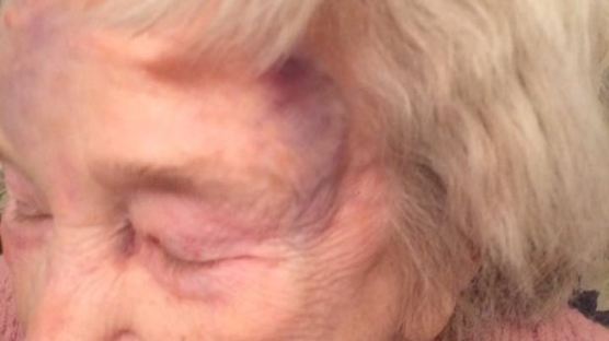 죽은 남편과의 결혼 반지 지키려다 강도에게 폭행당한 87세 할머니 