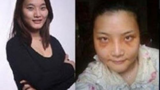 연예인 닮으려 수천만 원 써 '5시간' 성형한 여성