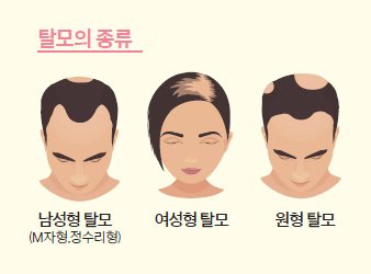 건강한 가족] 먹고 심고 발라 탈모 완화, 영양주사 맞아 발모 촉진 | 중앙일보