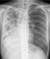 폐결핵 환자의 흉부 X선 사진. 결핵이 심하게 진행돼 폐가 하얗게 변했다. [중앙포토]