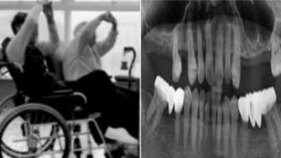 “노년기 빠진 치아 방치하면 인지장애 위험 2.7배”