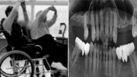 “노년기 빠진 치아 방치하면 인지장애 위험 2.7배”