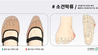 키높이 깔창을 사용하면 걸릴 수 있는 병