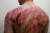  지난 21일 홍콩 위안랑역에서 괴한이 휘두른 쇠막대와 각목에 맞아 온 몸에 상처를 입은 시위참가자 케빈 소. [로이터=연합뉴스]