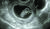 임신 8주차가량 된 태아 초음파사진.[중앙포토]