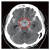 뇌지주막하출혈의 뇌CT 사진. 뇌 가운데에 흰색으로 보이는 별모양의 급성 출혈이 보인다. [강동경희대병원]
