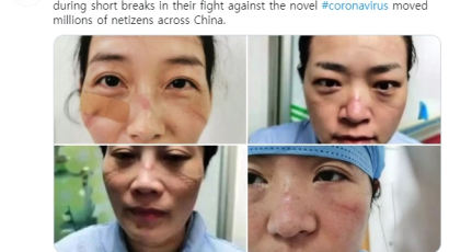 얼굴과 손엔 상처 가득···신종코로나 맞선 후베이성 간호사들