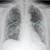 X레이로 이상이 포착된 3명 중 B 환자의 엑스레이 소견. 원래 검게 찍혀야 할 폐가 전반적으로 뿌옇게 찍혔다. 폐렴이 있다는 신호다. [사진 KJR]