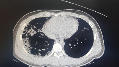 폐렴에 숨진 17세 CT 공개···빠른속도로 폐가 하얗게 변했다