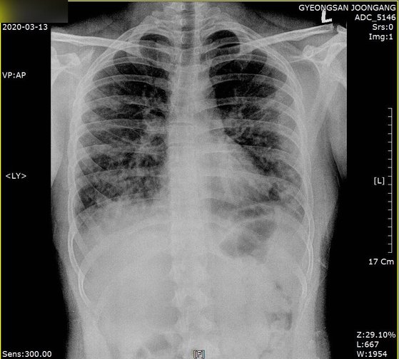 폐렴에 숨진 17세 CT 공개···빠른속도로 폐가 하얗게 변했다 | 중앙일보