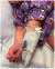 4월달 미국 소아과 학회가 발표한 가와사키 병을 앓고 있는 아이의 모습. 팔 등에 피부발진이 생겼다. 생후 6개월의 이 아이는 코로나19 양성 판정을 받았다. [미국 소아과 협회 제공]