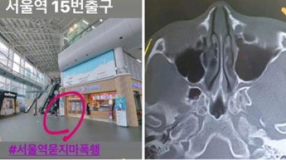 대낮에 서울역서 묻지마 폭행당한 30대 여성···"광대뼈 함몰"