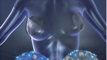 유방 확대시 실리콘 이물반응 줄인다…보라매 병원 연구진 국제학술지 표지 논문 선정