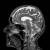 이와사키 아키코 박사 연구팀의 연구 결과는 지난 7월 코로나19 사망자 뇌 부검 결과와 일치힌다. 사망자 뇌 조직을 검사한 결과 산소공급 부족으로 인한 뇌손상이 발견된 바 있다. 사진은 코로나19 바이러스와 관련 없는 일반인의 뇌 MRI 사진. [픽사베이]