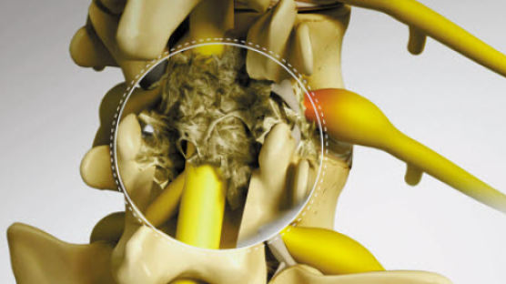 [라이프 트렌드&] 극심한 통증 유발하는 척추 유착성 질환 치료에는‘추간공확장술’이 효과적