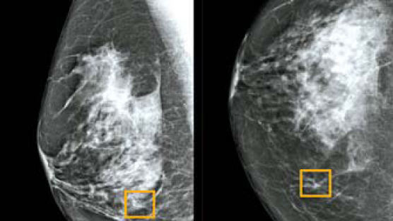 유방암 환자에 희소식...수술 전 항암치료 반응 AI로 조기 예측