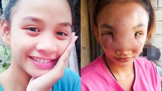 뾰루지 짰다가 풍선처럼 얼굴 부풀었다…필리핀 소녀의 눈물