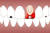 인체에서 가장 단단한 조직인 치아는 겉모습과 달리 그 내부에 신경과 혈관이 합쳐진 연조직 형태의 ‘치수’라는 것이 있다. [사진 pixabay]