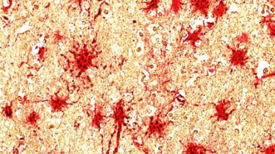 치매 원인 '뇌염증' 차단···국내 연구진 'C8-감마' 단백질 찾았다