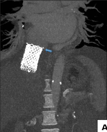 시술 3일 후 촬영한 CT 영상에서 판막은 삽입된 위치에서 변동이 없이 우심방 입구부터 하대정맥에 걸쳐 있다.
