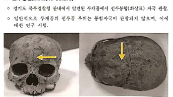 [단독]깨진 두개골만 7년 팠다, 美학술지 실린 韓검시관 성과