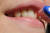 신경치료가 성공적으로 된 치아는 부서지지 않고 유지되면서 치아 주변 조직에 문제가 없는 한 씹는 기능은 충분히 할 수 있다. [사진 pixabay]