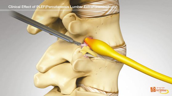 라이프 트렌드&] 수술적 기법 접목해 다양한 척추질환 치료에 효과적인 '추간공확장술' | 중앙일보