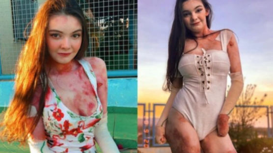 '온몸 물집' 사진 당당히 올렸다···브라질 희귀병 소녀 사연