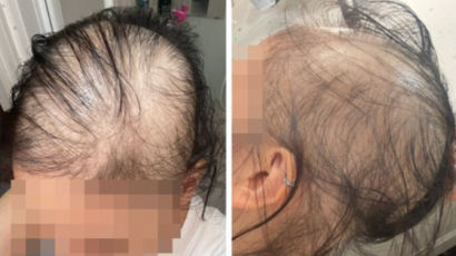 20대 日여성 후유증 "모더나 맞고 대머리, 가발 쓰고 출근" 
