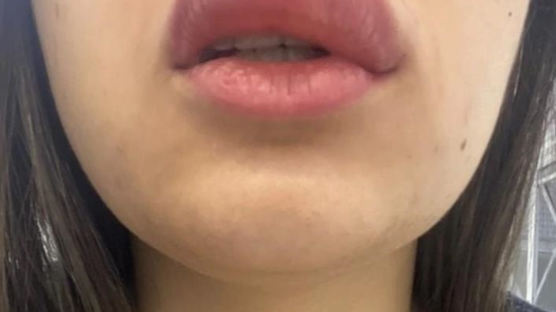 눈뜨니 거대해진 입술…한밤 21세女 입술 덮친 범인 정체