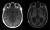 건강한 뇌(왼쪽)와 알츠하이머를 앓고 있는 환자의 뇌. [AFP=연합뉴스]