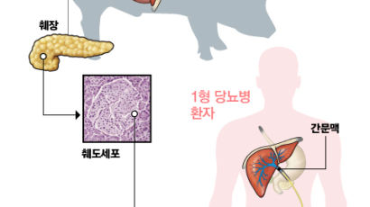 한국은 돼지 췌도, 사람 간에 이식…당뇨병 치료 도전