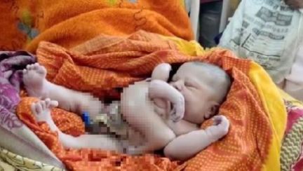 팔·다리 4개인 아기 탄생…"신의 현신" 인도가 발칵 뒤집혔다