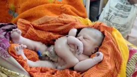 인도에서 팔·다리 4개인 아기 태어나… 사람들 몰려 사진찍는 이유는