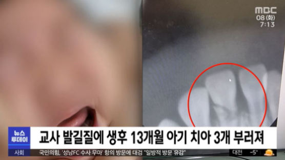 "7개월 아기에 발길질…치아 3개 부러졌다" 어린이집 CCTV 충격