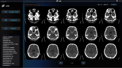 휴런 뇌출혈 진단 AI 소프트웨어, 식약처 3등급 의료기기 허가 승인