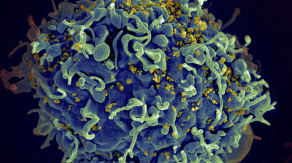 에이즈 정복하나…HIV 감염된 백혈병 여환자 완치 성공했다