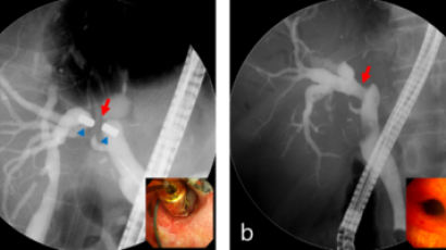 강남세브란스, 막힌 담즙관 자석으로 뚫는 시술 102건...성공률 93%