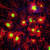 알츠하이머병 환자의 뇌. 미세아교세포(붉은색)가 아밀로이드-베타 플라크(녹색)을 둘러싸고 공격하는 모습. 변형된 아밀로이드 단백질 플라크는 알츠하이머 병의 주요 원인이다. [UCI]