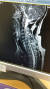 2014년 박위씨의 MRI 사진. 낙상사고로 경추의 일부가 아예 끊어졌다. 박씨 제공