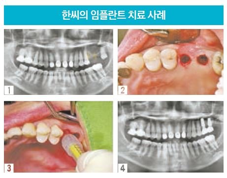 최소한의 치은 절개, 임플란트에 문제 없음 1