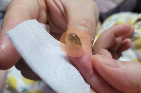 봉합수술을 받은 아기의 손. 인터넷 캡처