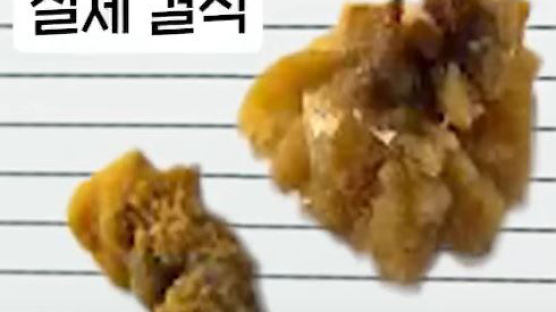 맥주 퍼마시면 '조용한 암살자' 온다…여름에 더 날뛰는 병