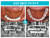 올온엑스 기법으로 아래턱에 5개의 임플란트를 식립해 보철물을 연결함으로써 치아 기능을 회복했다. 사진 더와이즈치과병원