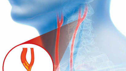 뇌경색·치매 막는 뇌혈류 길목...목젖 좌우 3cm '더블 Y' 지켜라 [건강한 가족]