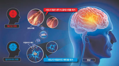 치매환자 분석하니 전조가 있었다…고혈압·혈당 그리고 '이것' [건강한 가족]